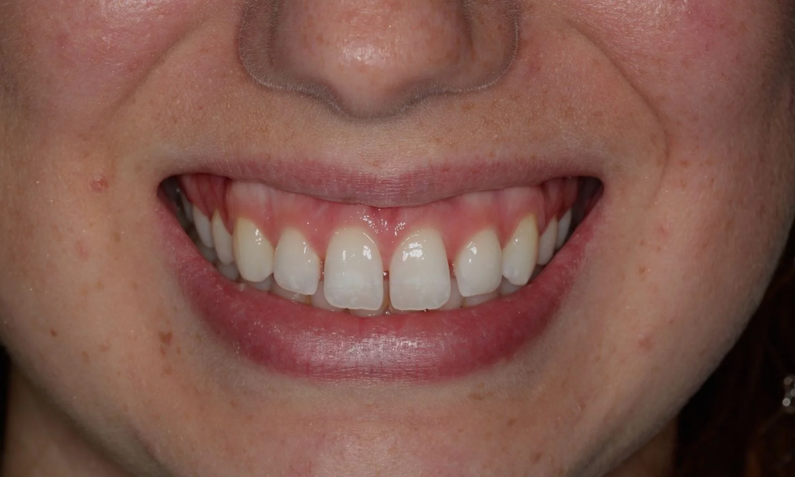 Dental Veneers - Before