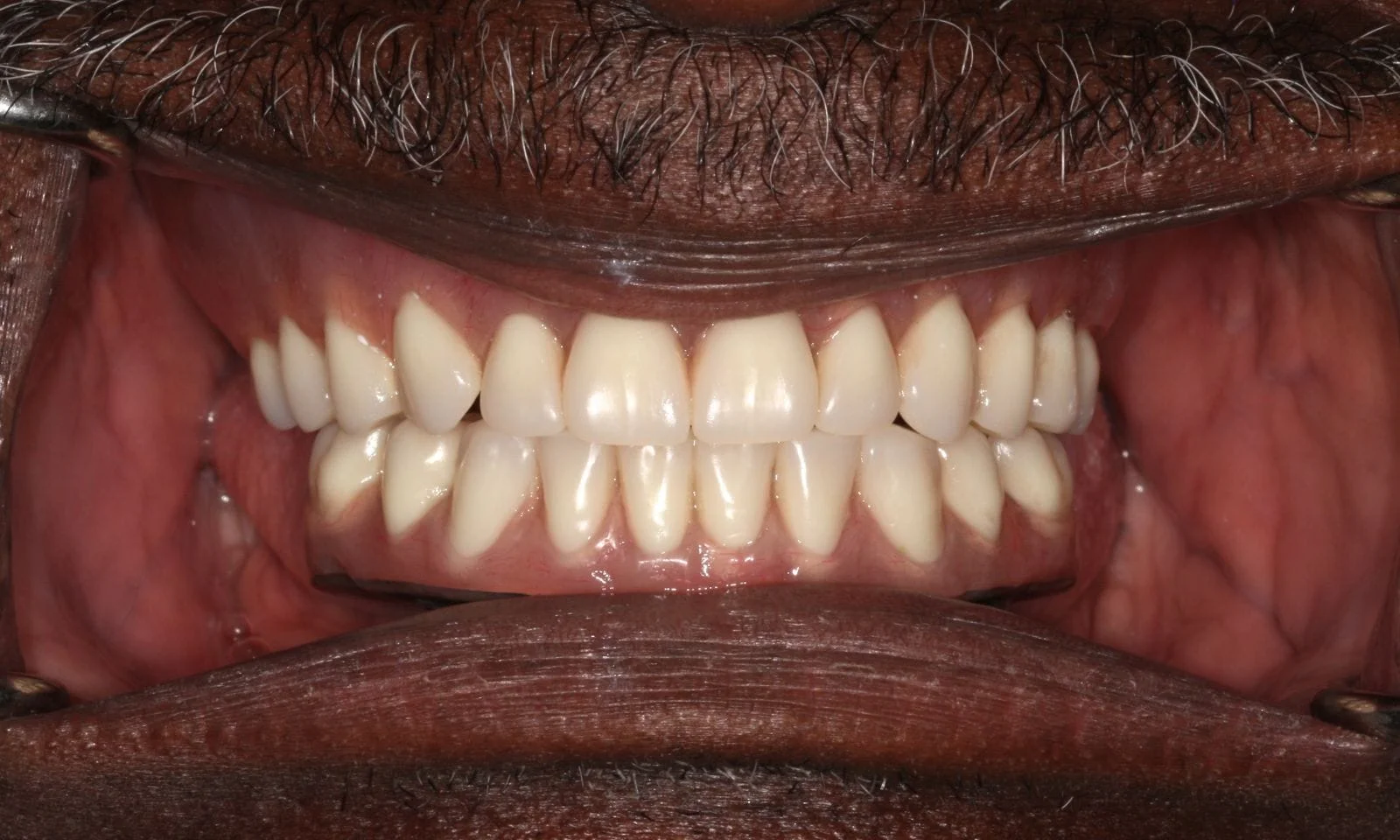 Implant Denture - After