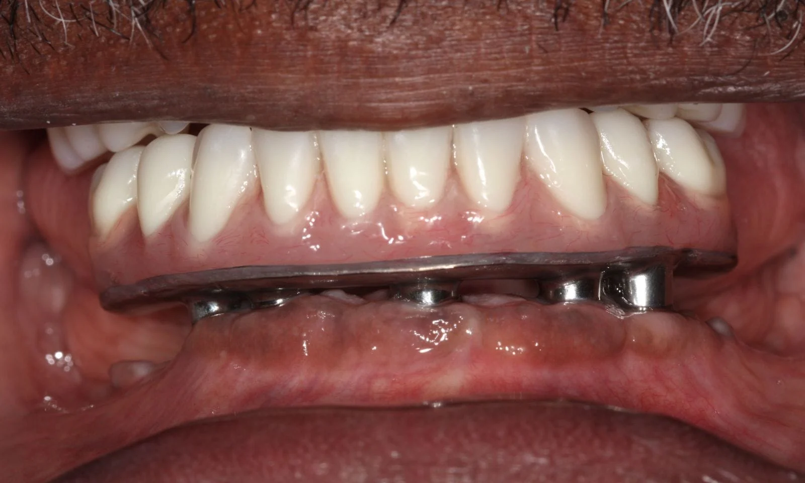Implanted Lower Denture - After