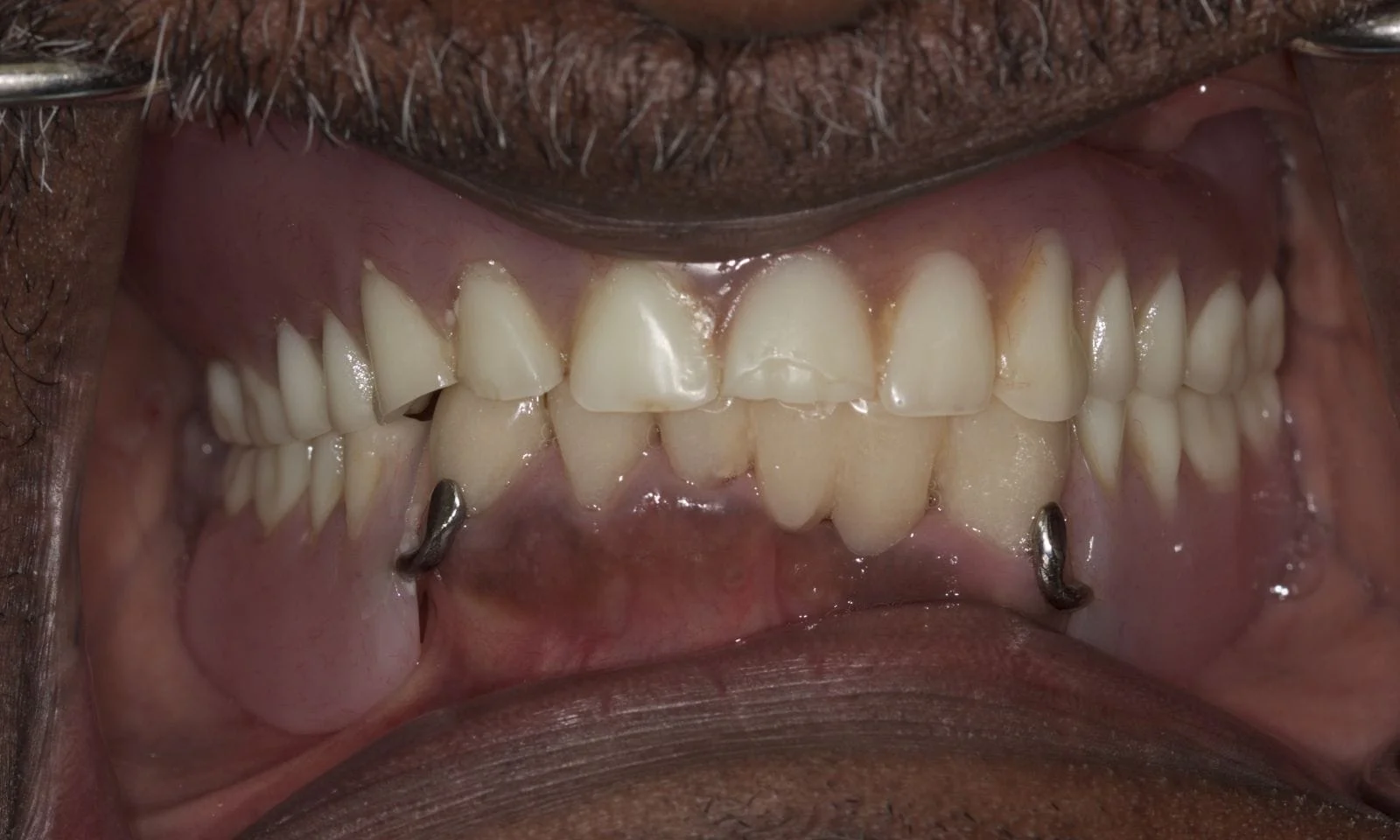 Implant Dentures - Before
