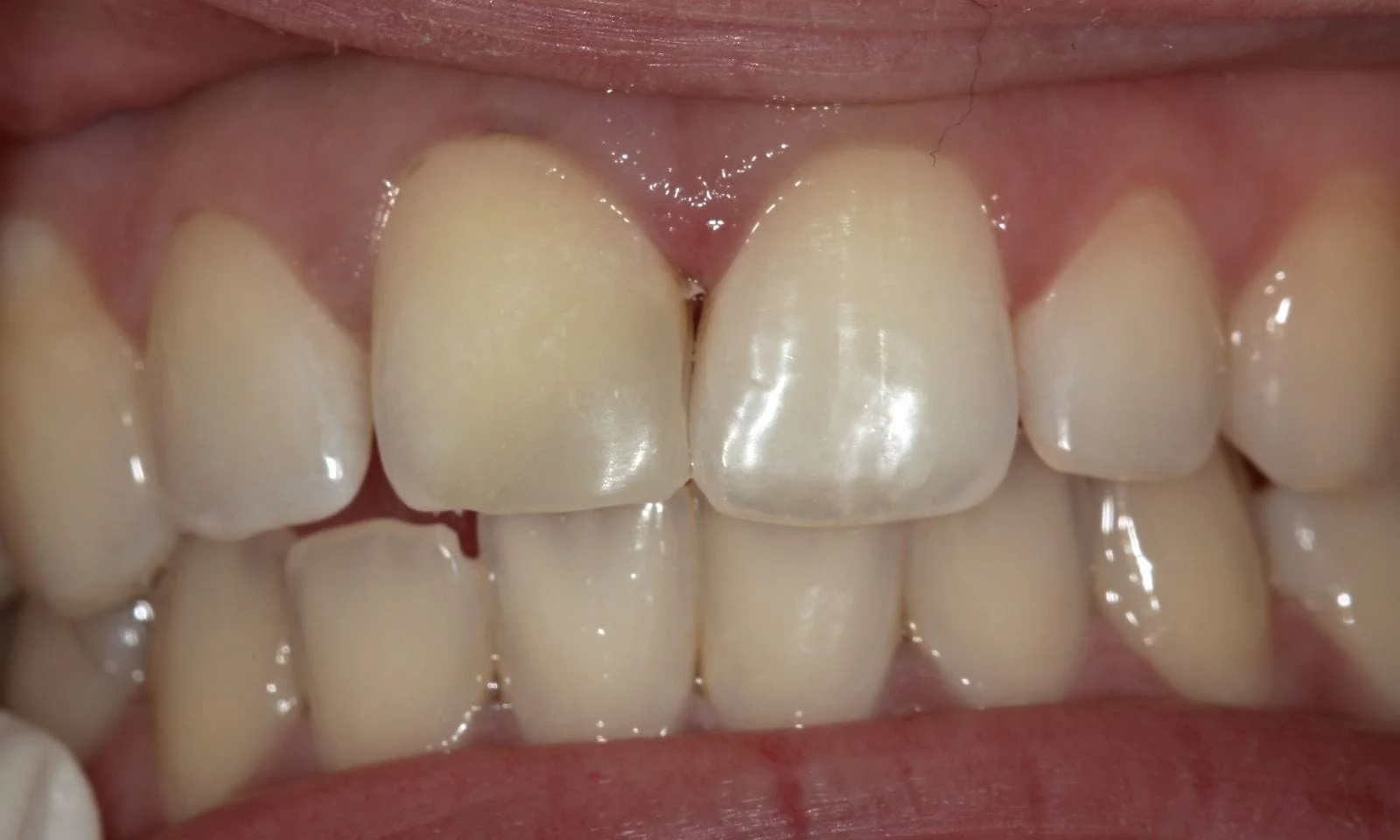 Chipped Tooth - After