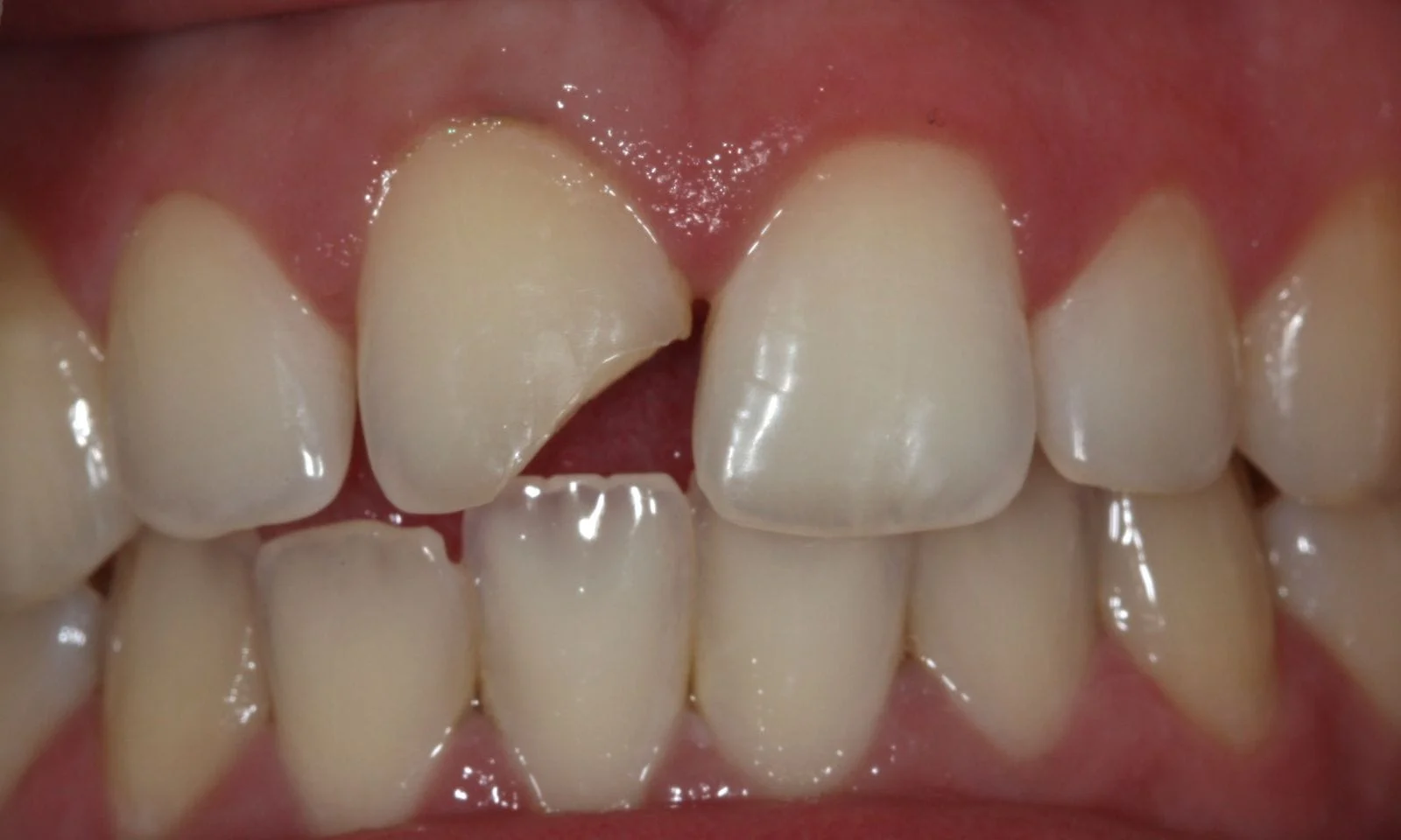 Chipped Tooth - Before