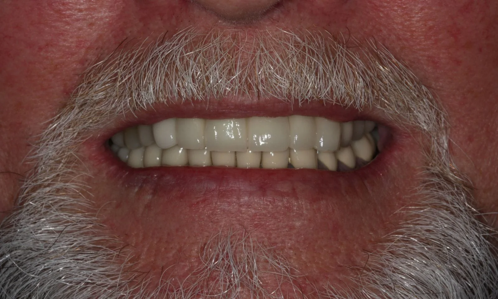 Dental Bridge Tooth Replacement - After