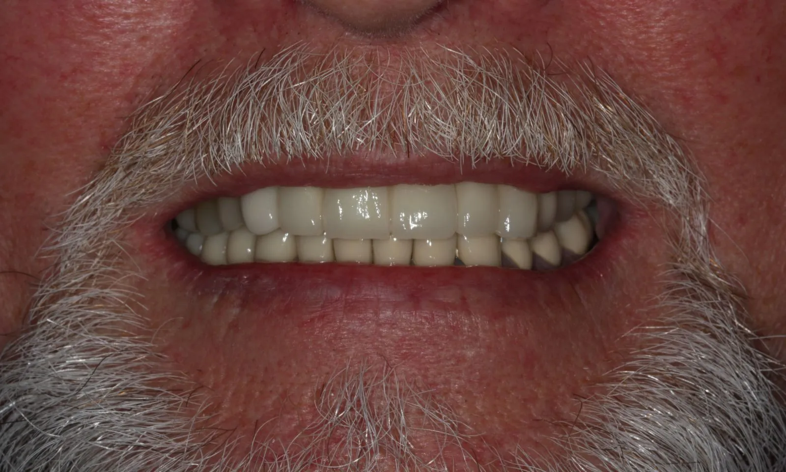 Dental Bridge Tooth Replacement - After