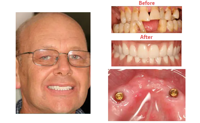 bald man with glasses smiling showing dentures, before and after image of missing teeth and implant dentures New Baltimore, MI dentist