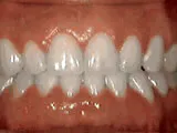 Spacing of Teeth Springfield NJ | Springfield Orthodontics