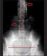 Low Back X-ray - Before Chiropractic Treatments - Mild Scoliosis (9 degree Cobb Angle)