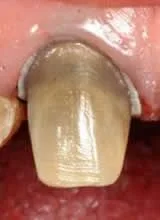 Root_Canal1