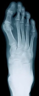 Des Moines Podiatrist | Des Moines Rheumatoid Arthritis | IA | Advanced Foot & Ankle Clinic |