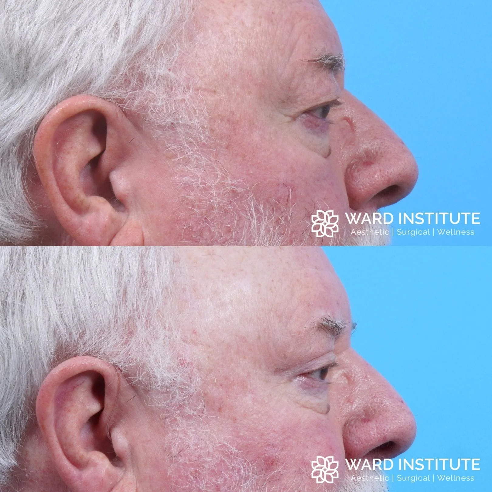 Male blepharoplasty patient B&A photo.