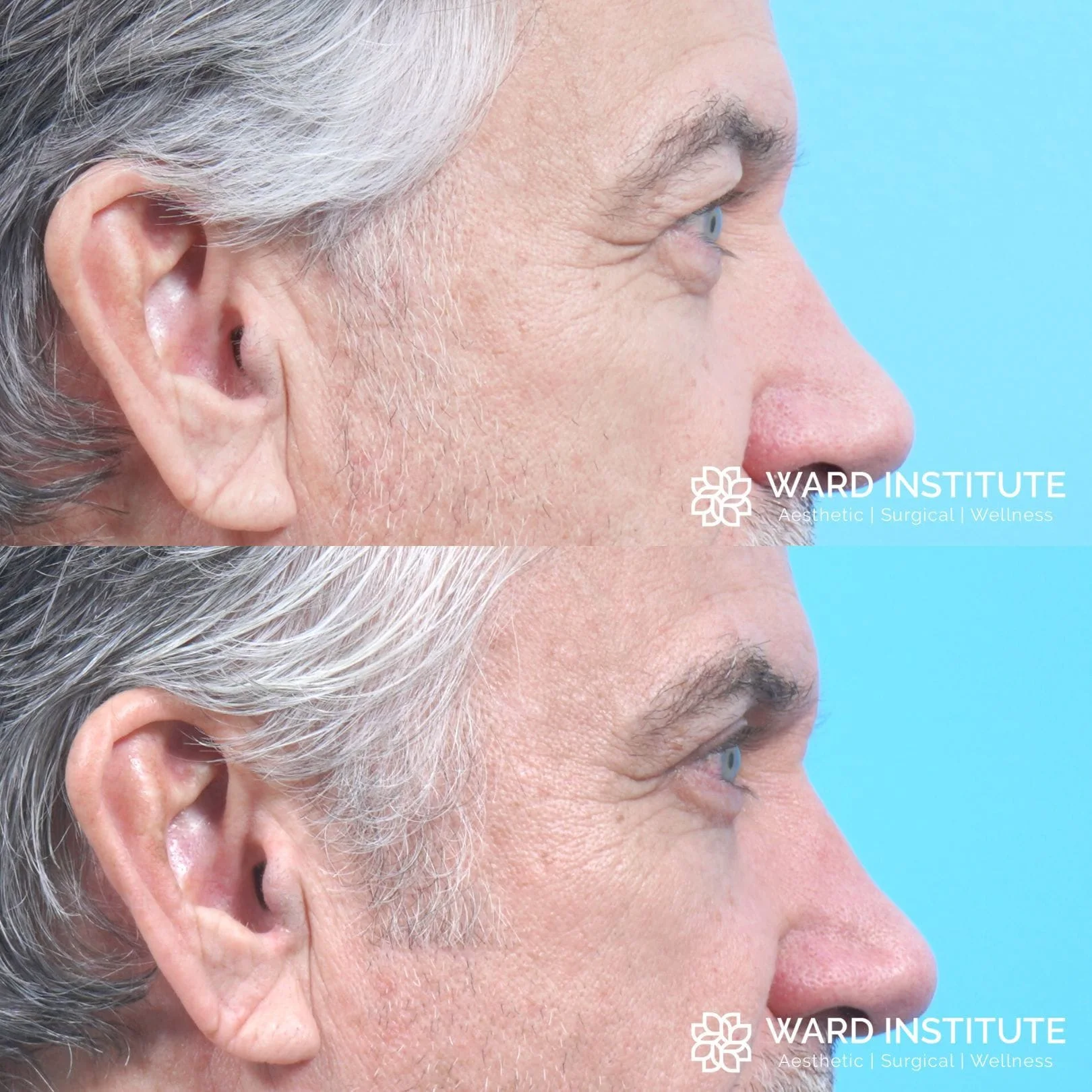 Male blepharoplasty patient B&A photo.