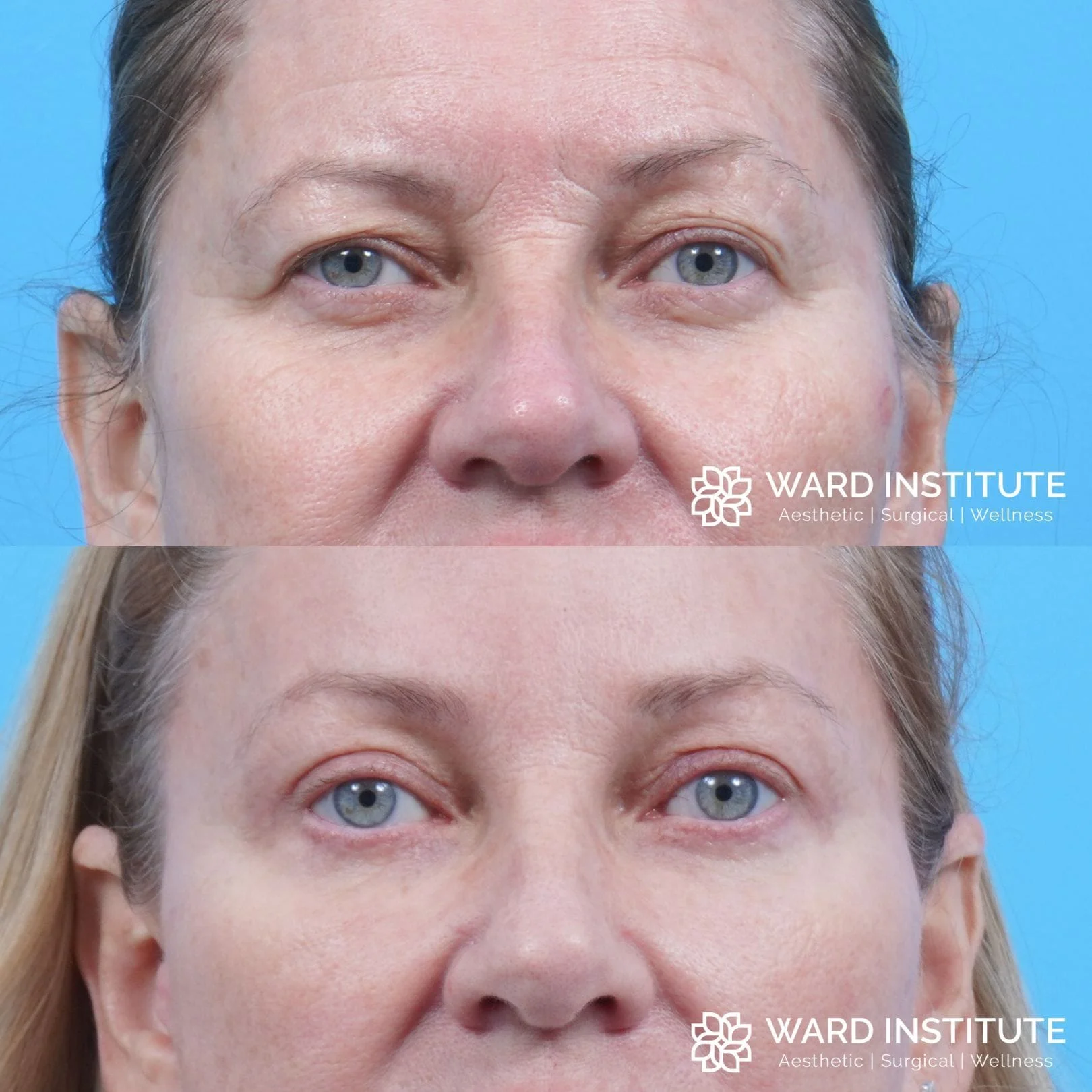 Eyelid lift before and after image.