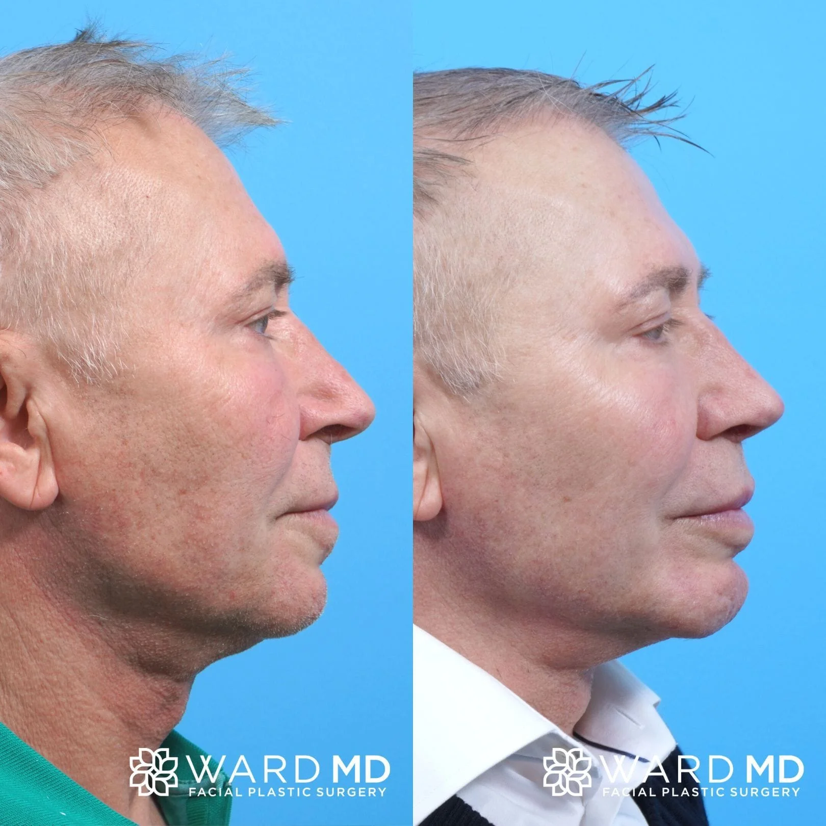 Male chin augmentation patient B&A photo.