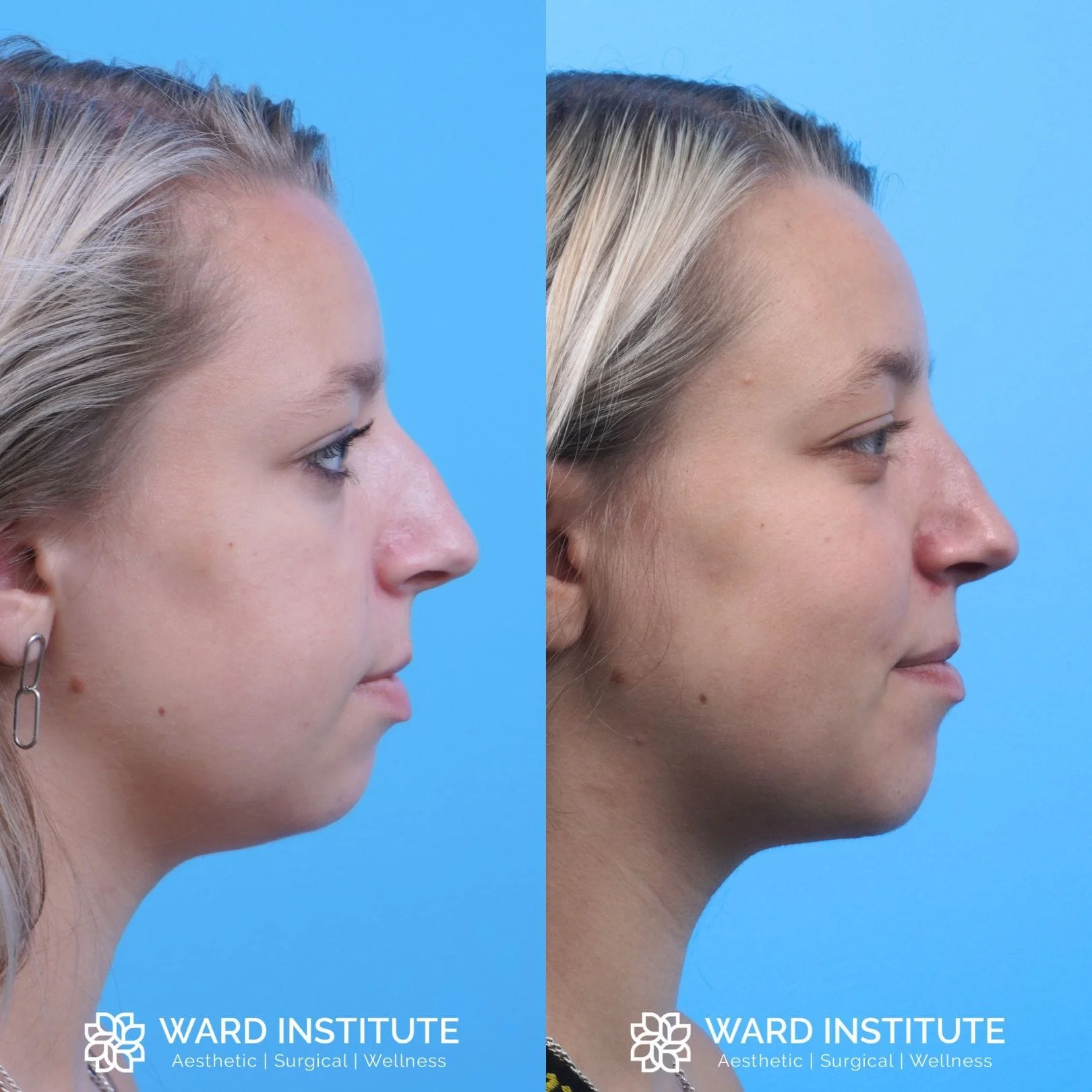 Women chin augmentation before and after image.