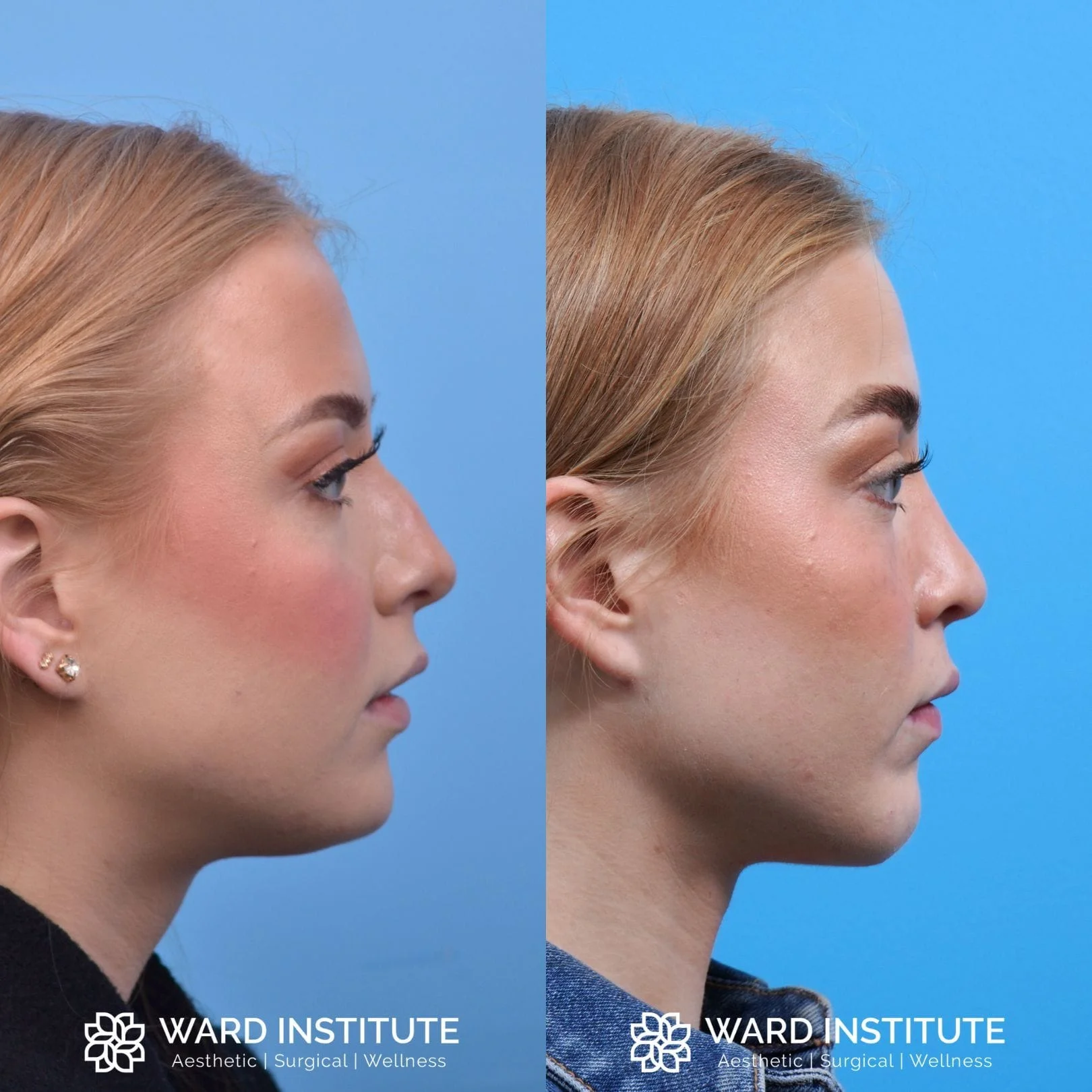 Female chin augmentation before and after image.