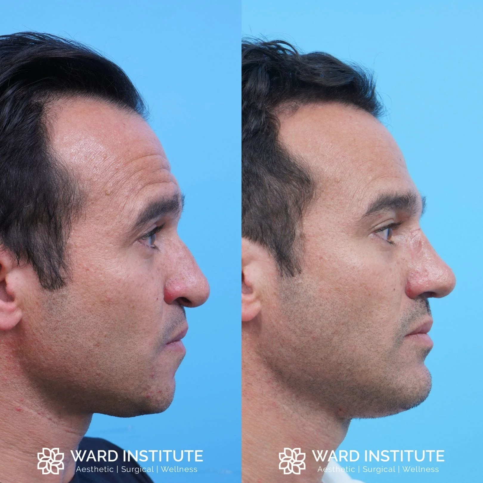 Male chin augmentation before and after image.