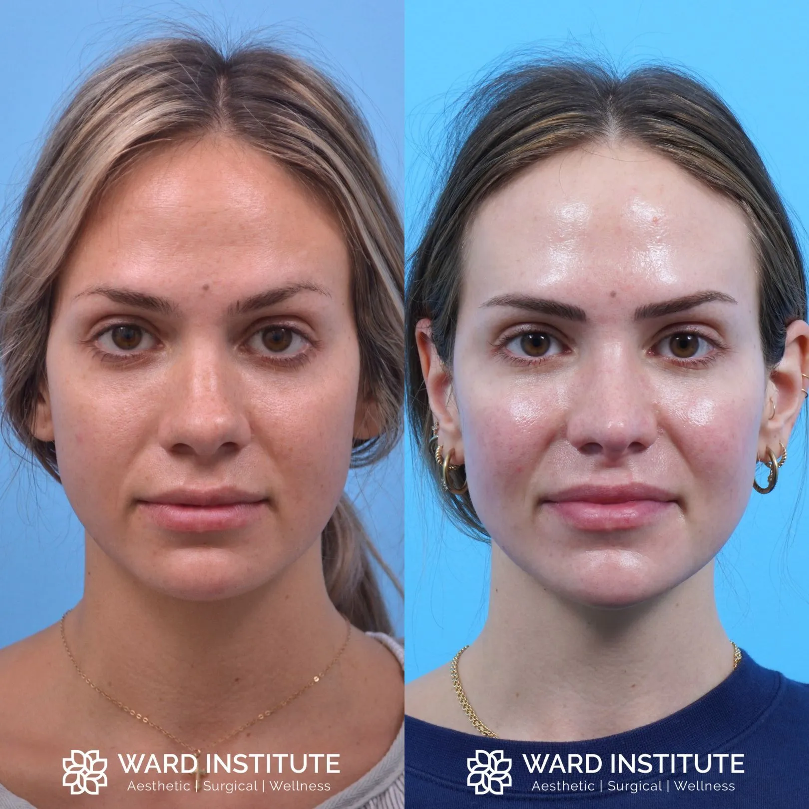 Female chin augmentation before and after image.