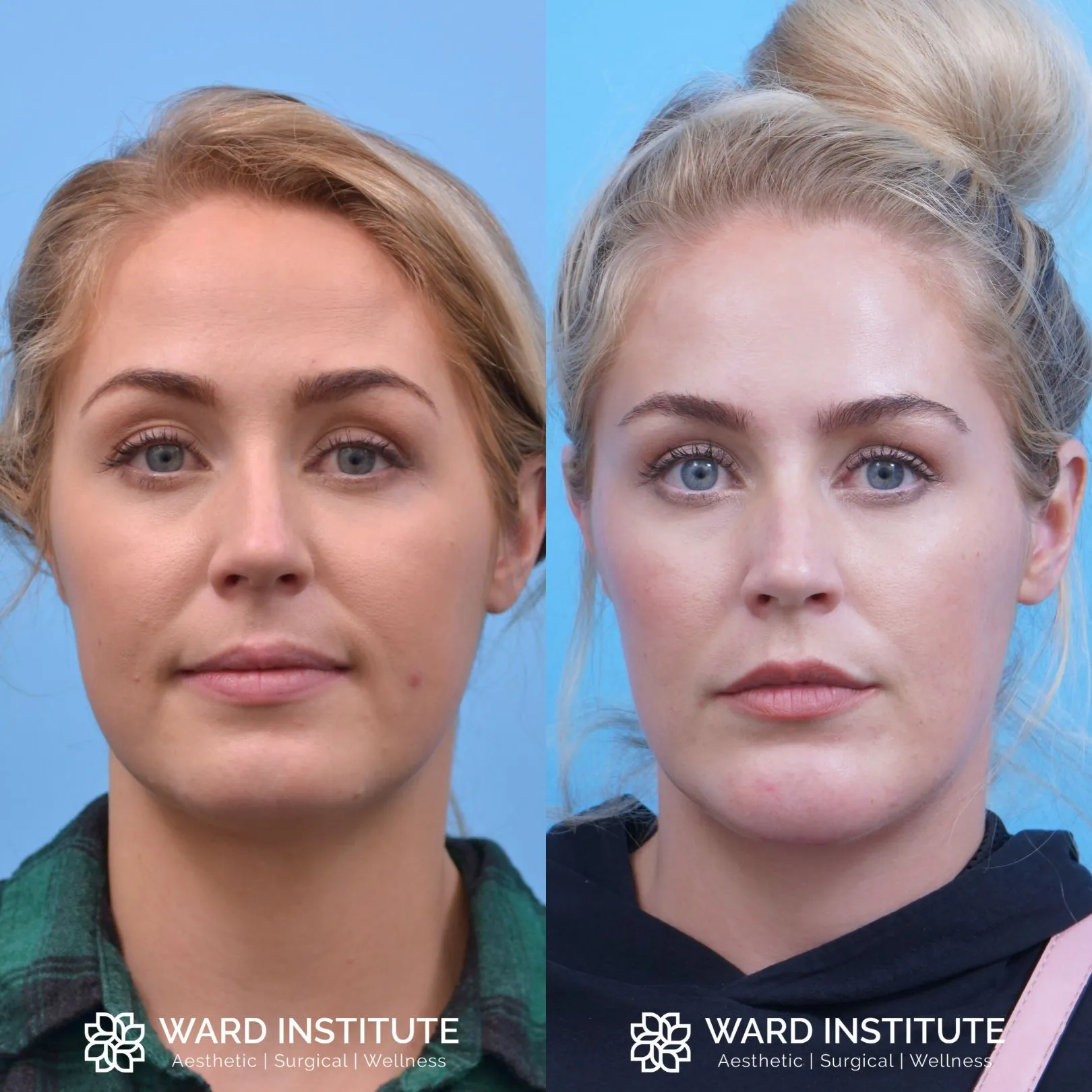 Female chin augmentation before and after image.