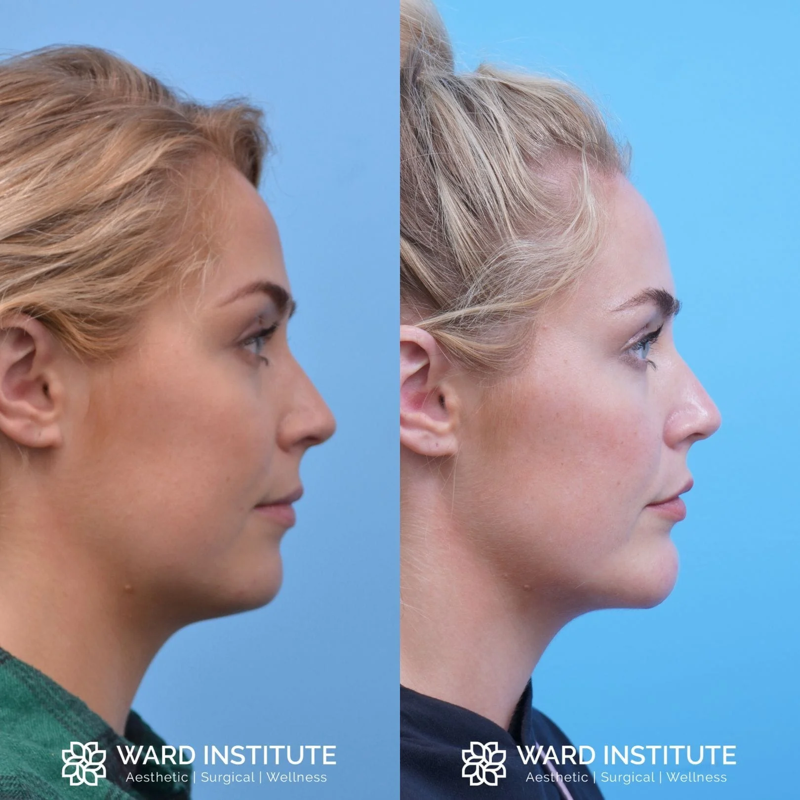 Female chin augmentation before and after image.