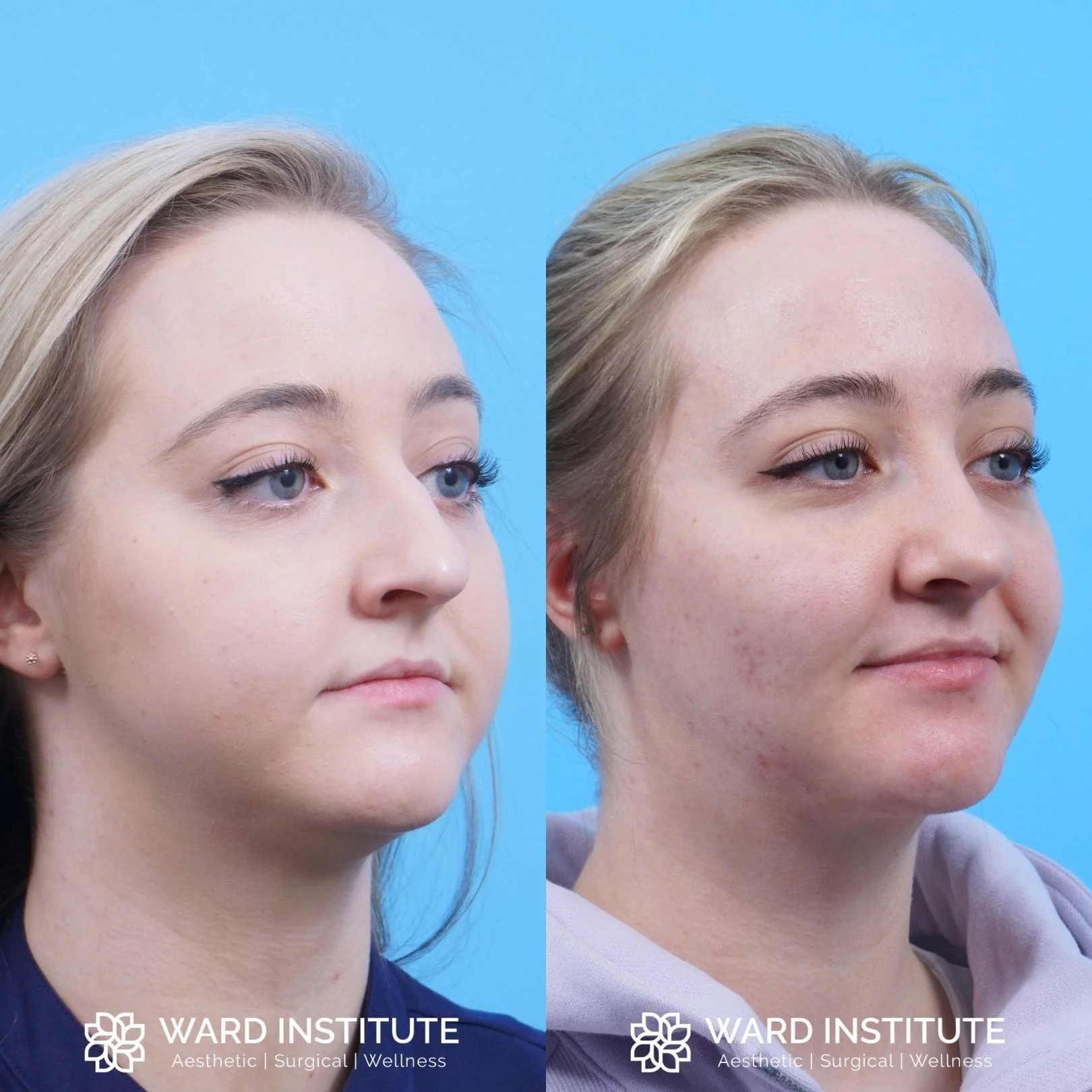 Women chin augmentation before and after image.