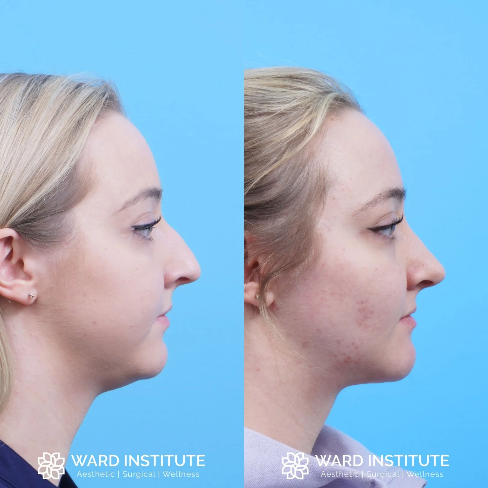 Women chin augmentation before and after image.