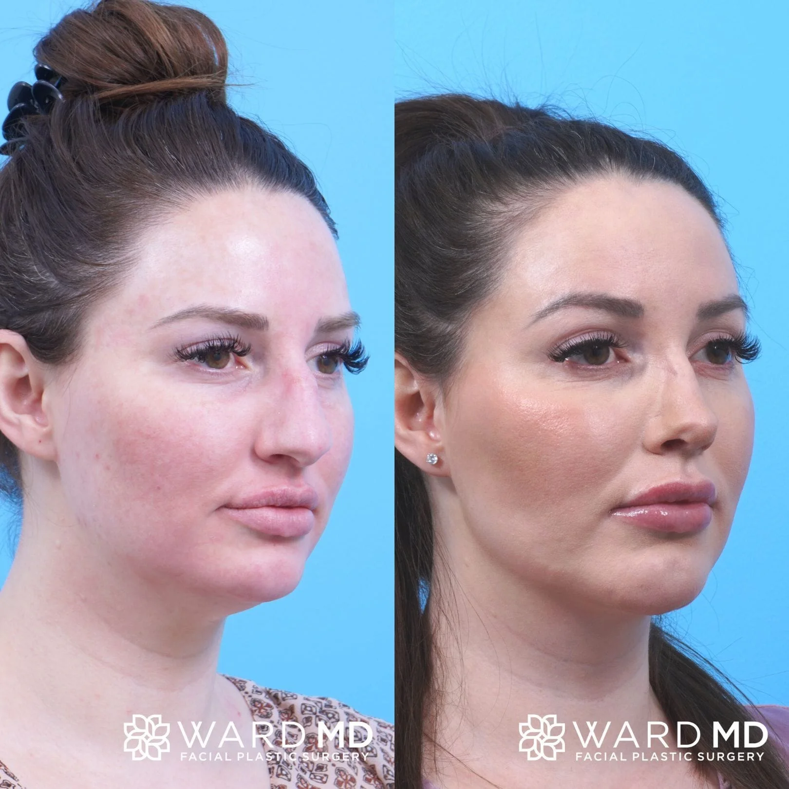 Facial contouring before and after image.