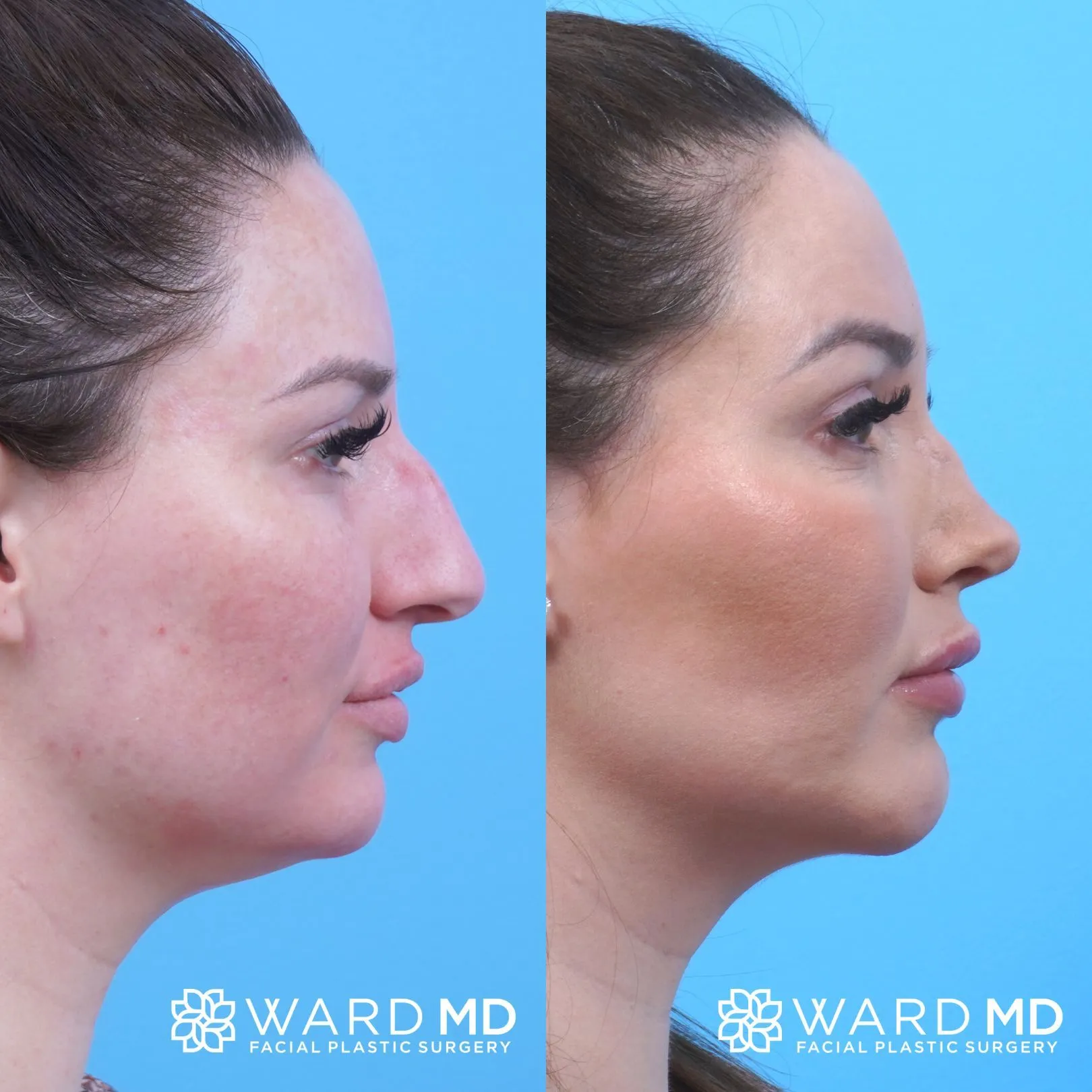 Facial contouring before and after image.