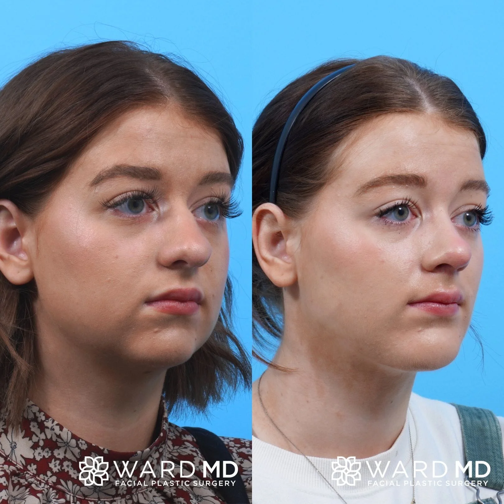 Young female facial contouring patient before and after photo.