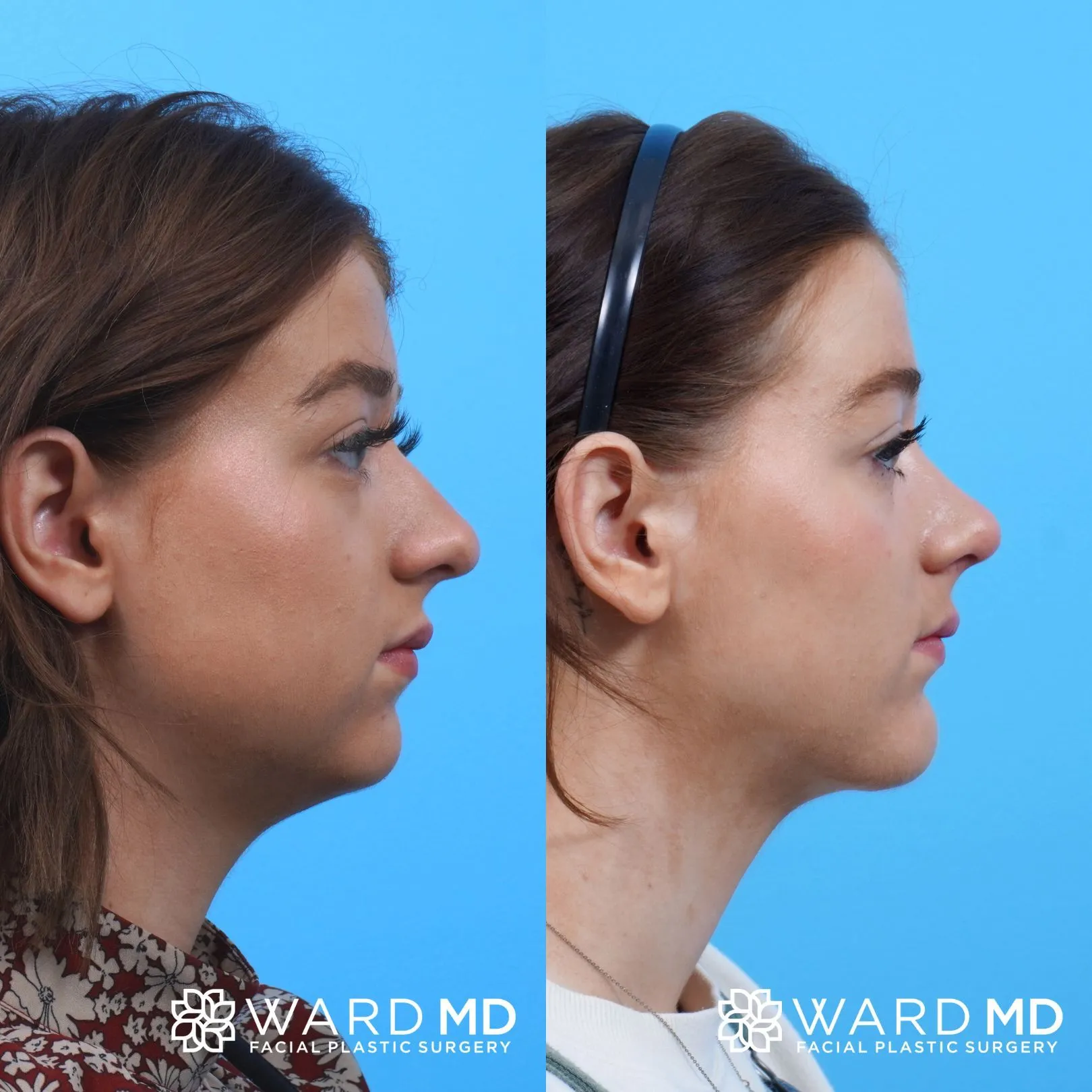 Facial contouring before and after image.