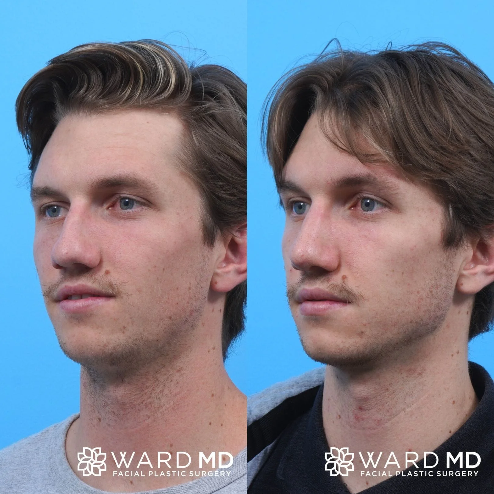 Male rhinoplasty before and after image.