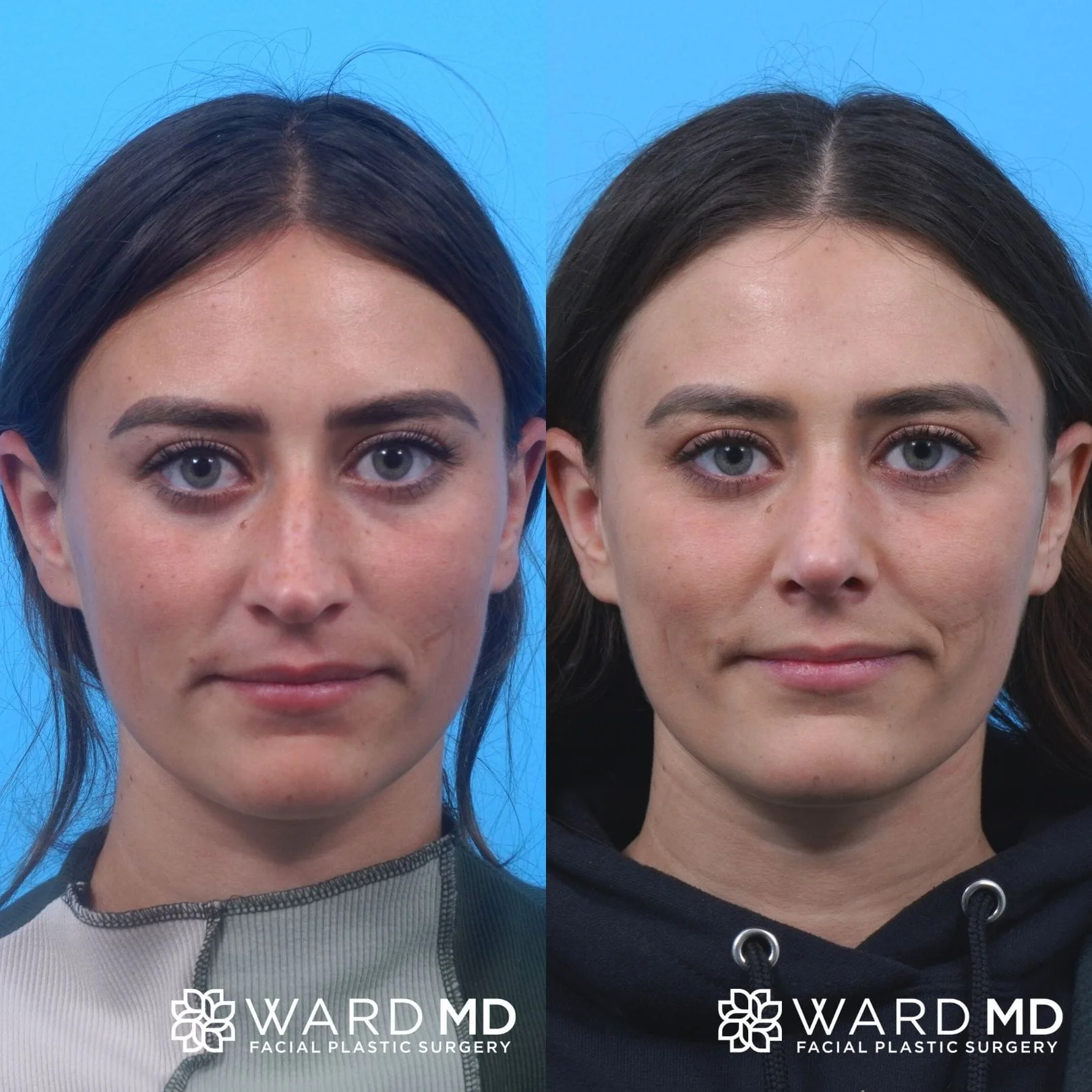 Female rhinoplasty before and after image.