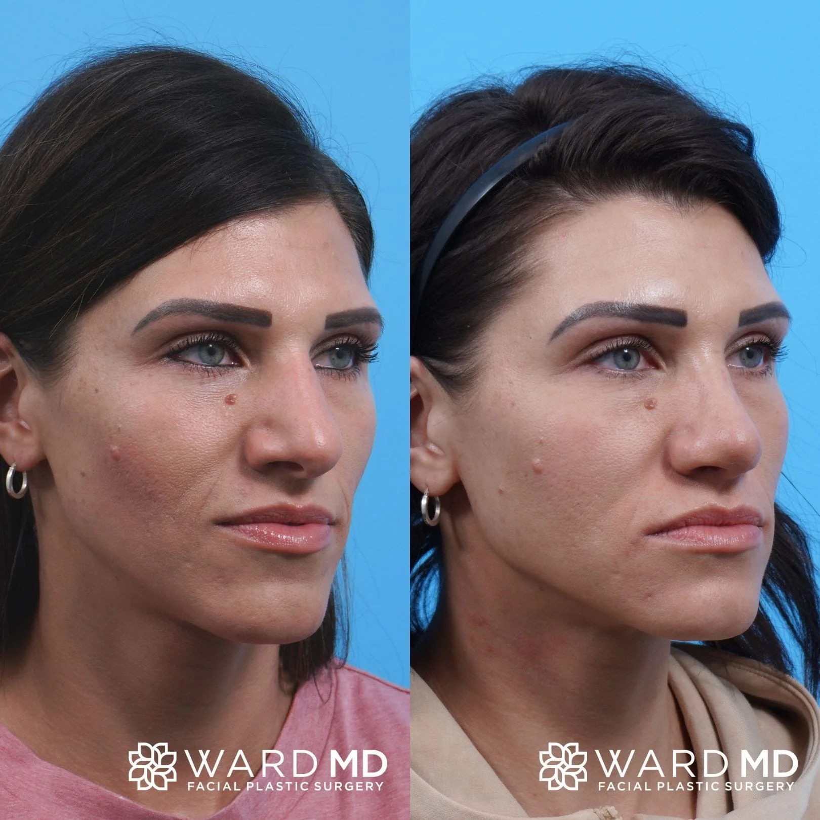 Female rhinoplasty before and after image.