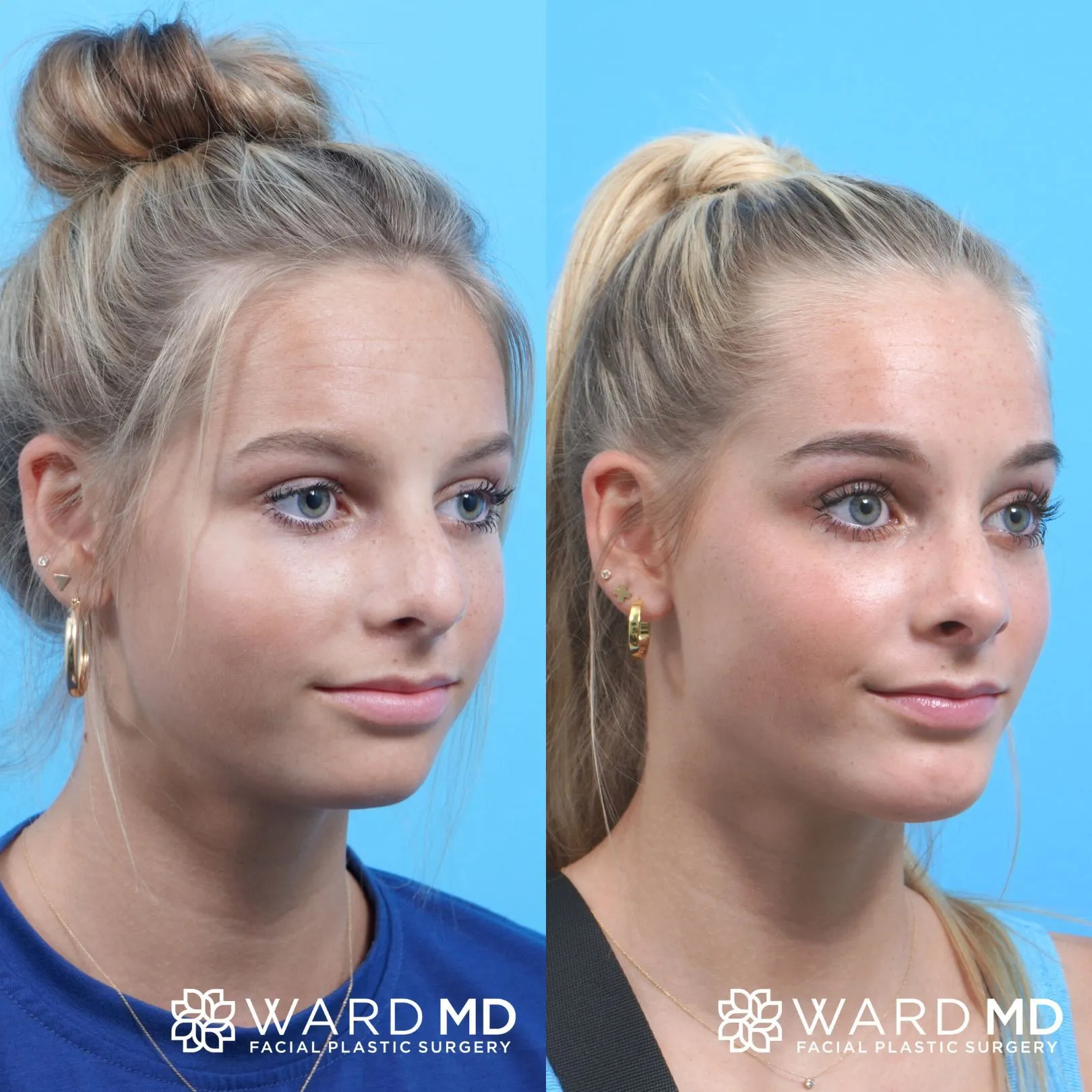 Female rhinoplasty before and after image.