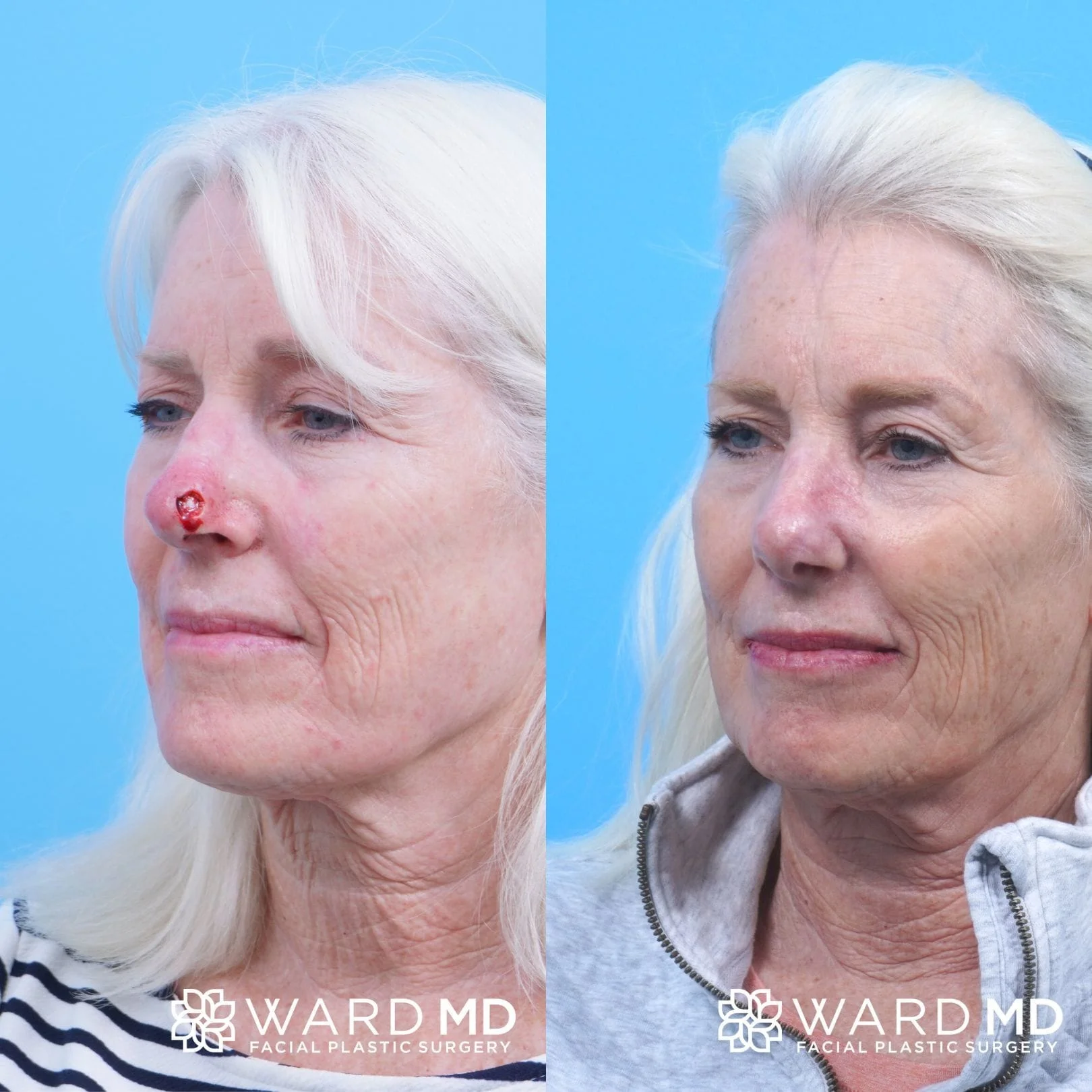 Female Skin Cancer reconstruction patient before and after photo.