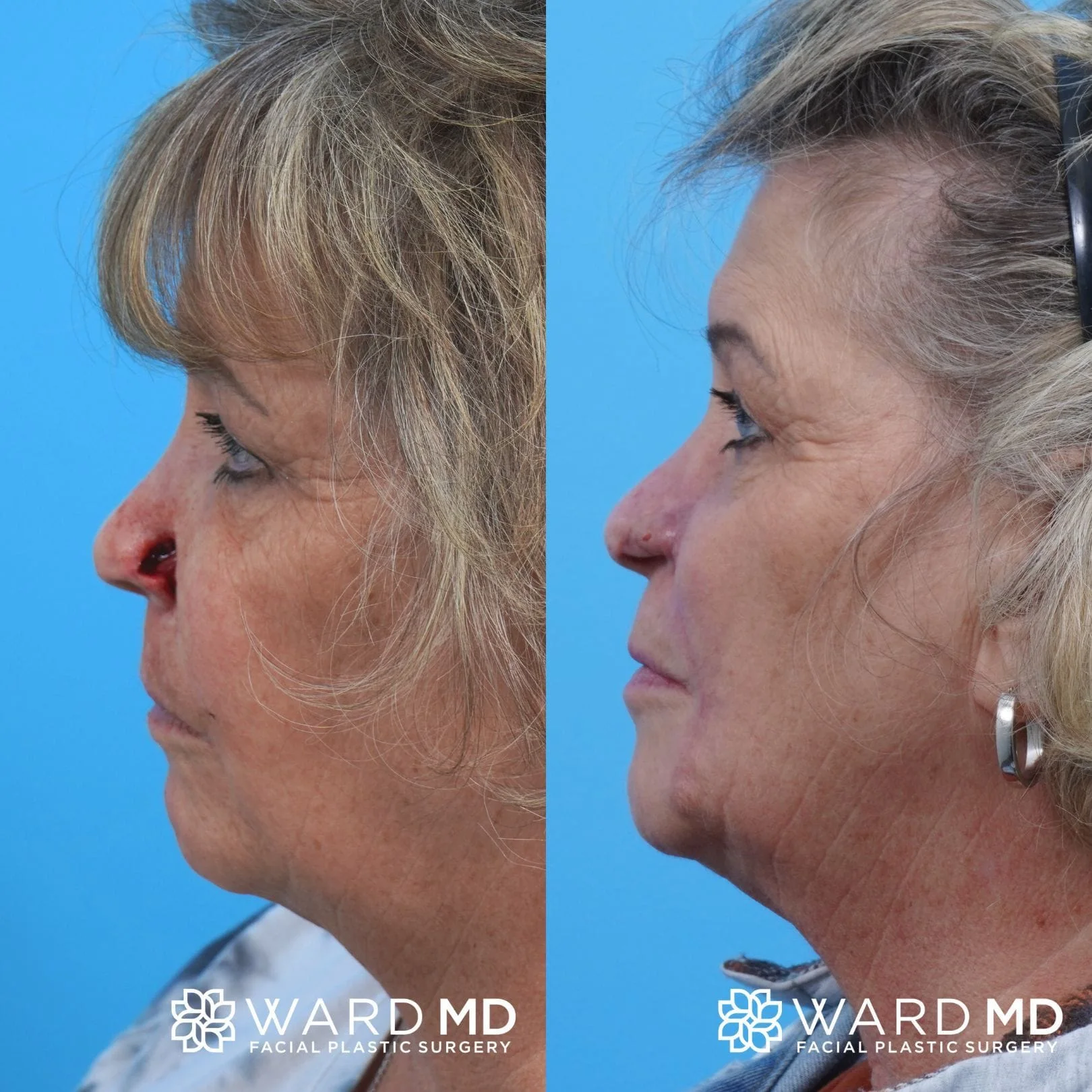 Female Skin Cancer reconstruction patient before and after photo.