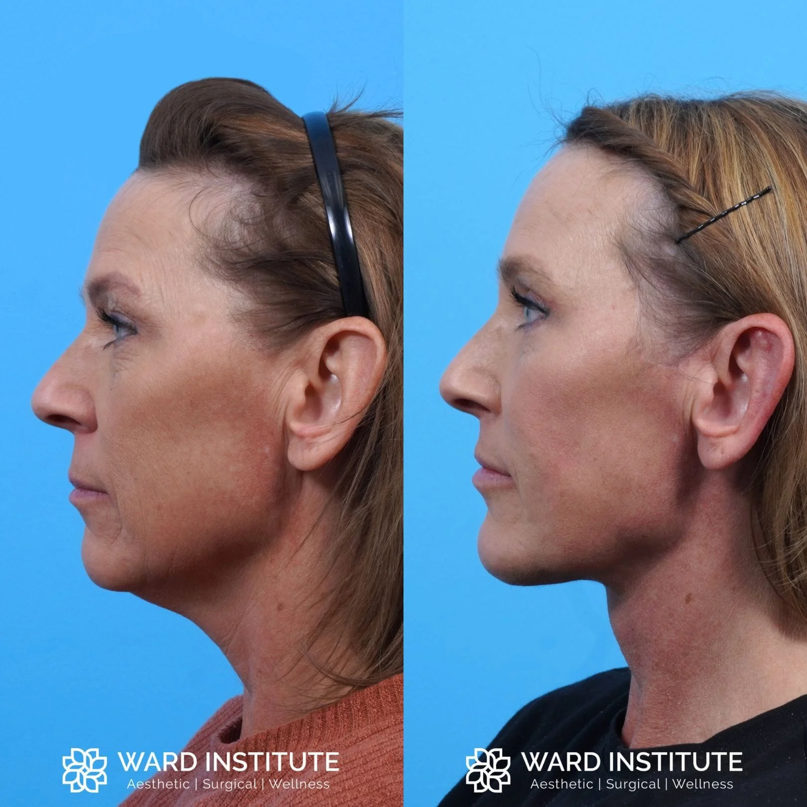Facelift Before and After Patient Photo