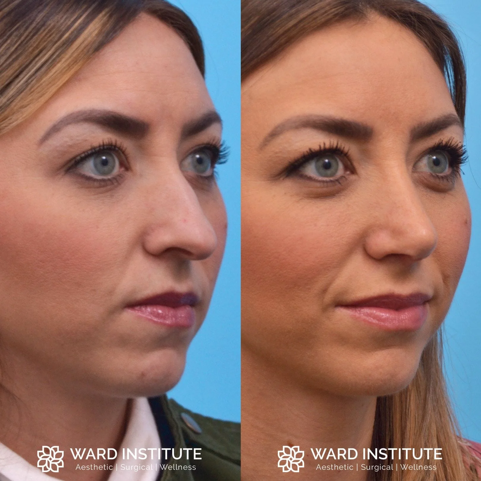Rhinoplasty Before and After Patient Photo