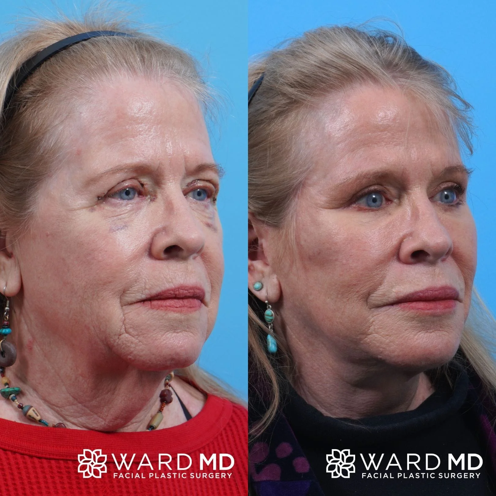 Facelift B&A