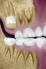 illustration of impacted tooth, need wisdom teeth extraction Royal Palm Beach, FL