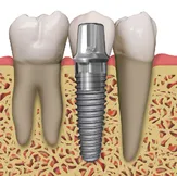 Dental Implants | Dentist in Saluda, SC | Saluda Smilemakers