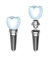 illustration of assembly of dental implants Old Bridge, NJ dentist