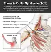 Thoracic Outlet Syndrome | Basalt, Aspen, Carbondale, Spine Spot Chiropractic