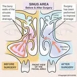 sinus surgery