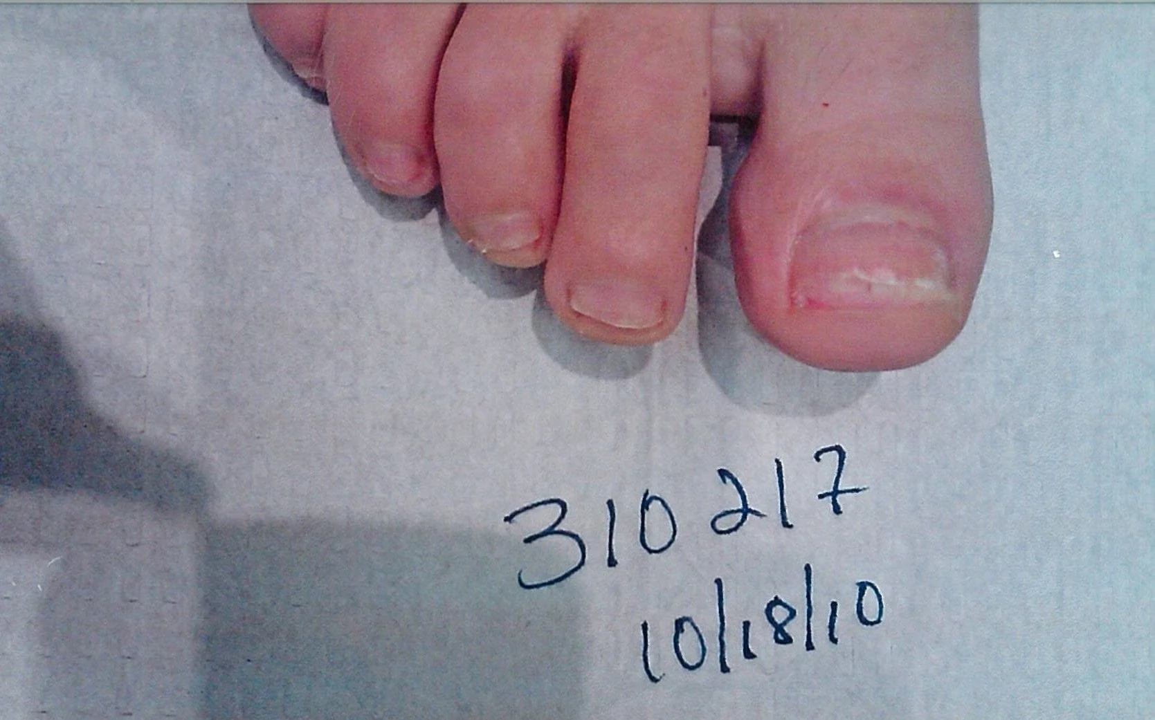 Patient 310217 Right Foot After