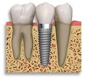 periodontal_disease.jpg