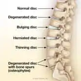 Osteoarthritis | Basalt, Aspen, Carbondale, Spine Spot Chiropractic