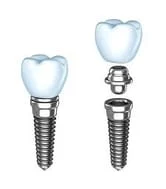 illustration of assembly of dental implants Baytown, TX