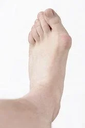 Bunions in Boise, Nampa, and Meridian, ID