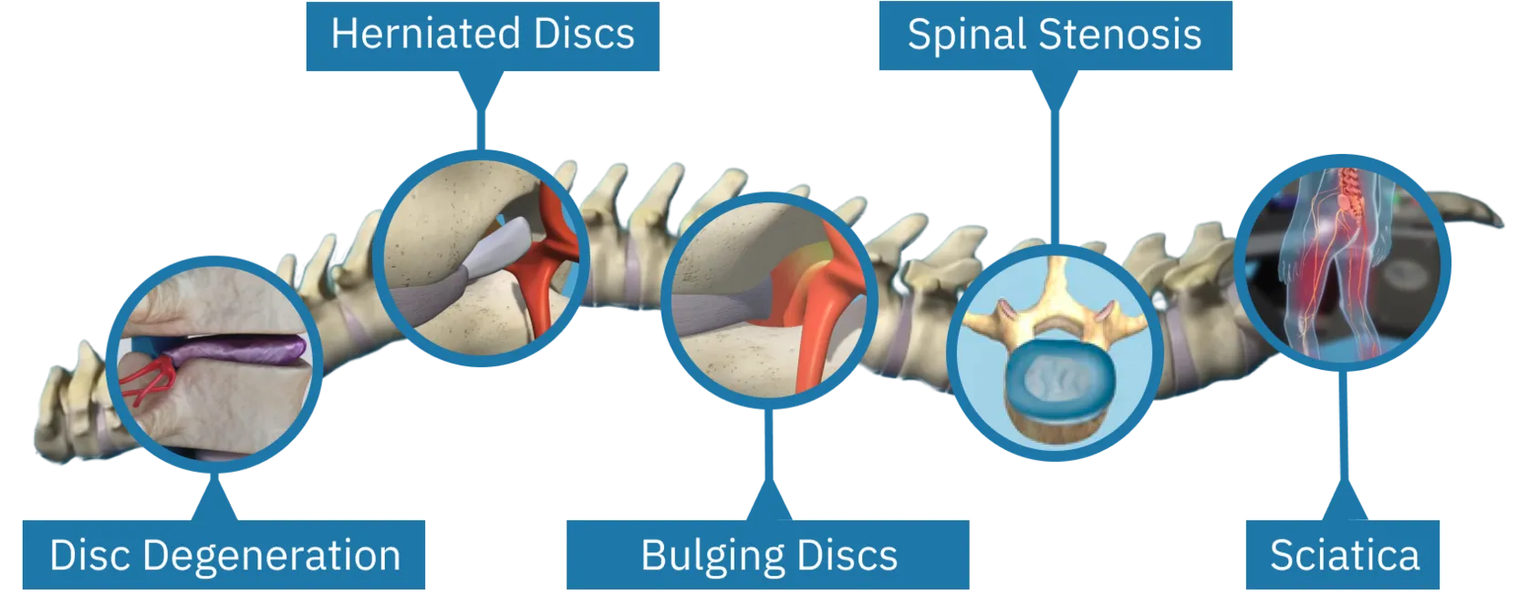 disc herniation treatment in winter park, fl