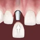 Dental Implants Woodbridges VA